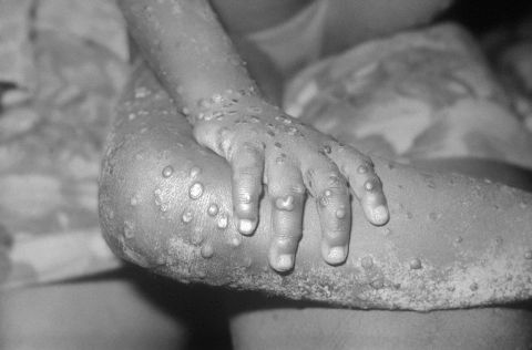 What is monkeypox? A microbiologist explains what’s known about this smallpox cousin