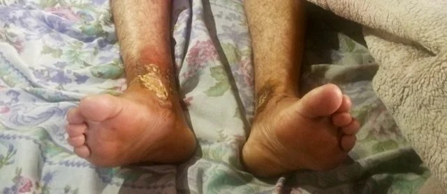 The feet of a kidnap for ransom victim - a Pakistani businessman - as he recovers at home