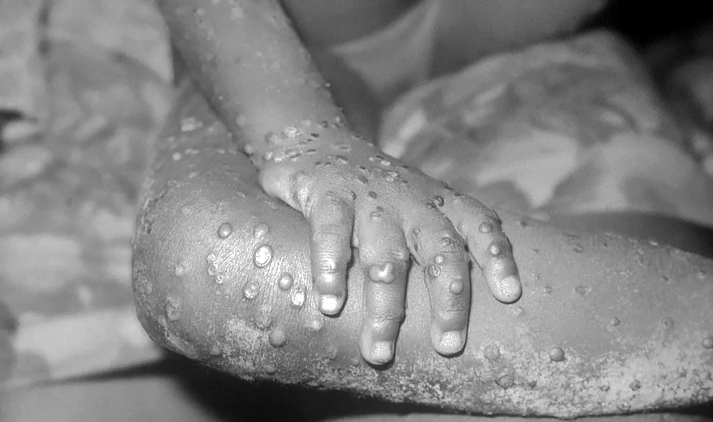 An image showing monkeypox lesions on a patient