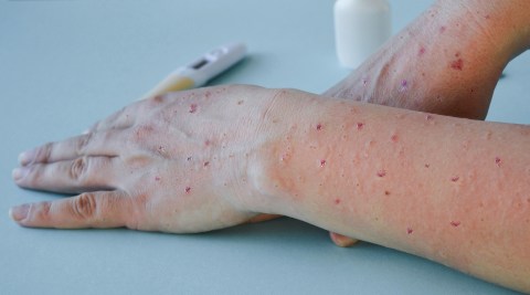 Contact tracing under way for first monkeypox case confirmed in SA