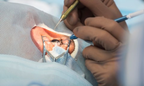 Cataract surgeries are backing up in the Western Cape, but it’s not a new problem
