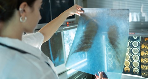 Digital X-ray screening for TB making inroads into diagnosing asymptomatic sufferers