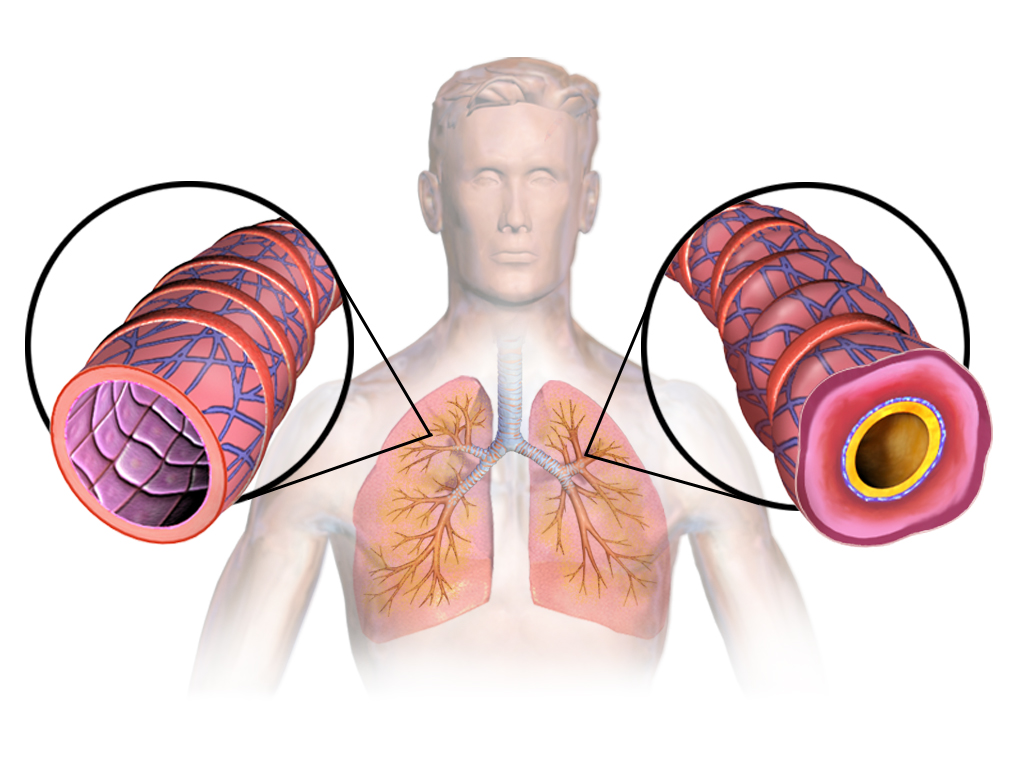 Asthma is caused by inflammation that leads to swelling and a narrowing of airways in the lungs, as seen in the right cutaway in this image. BruceBlaus/Wikimedia Commons, CC BY-SA