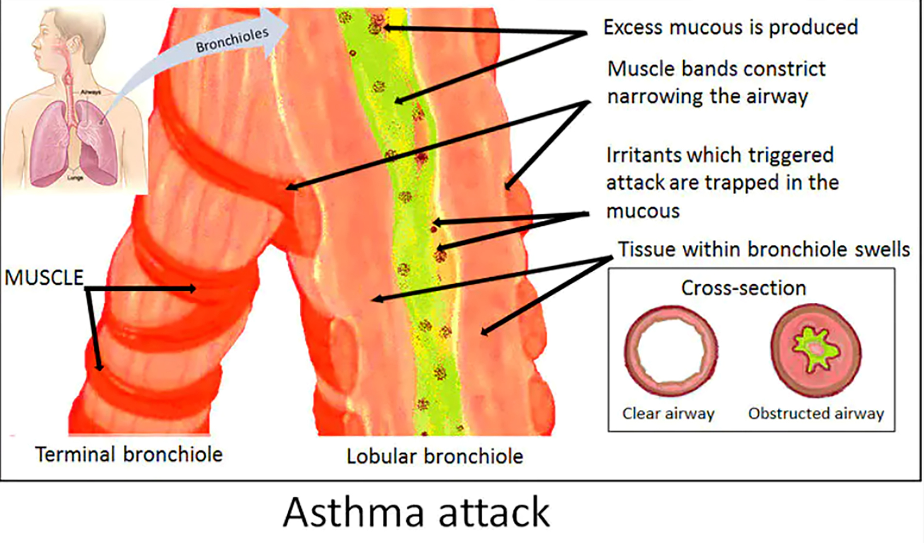 Asthma attach illustration