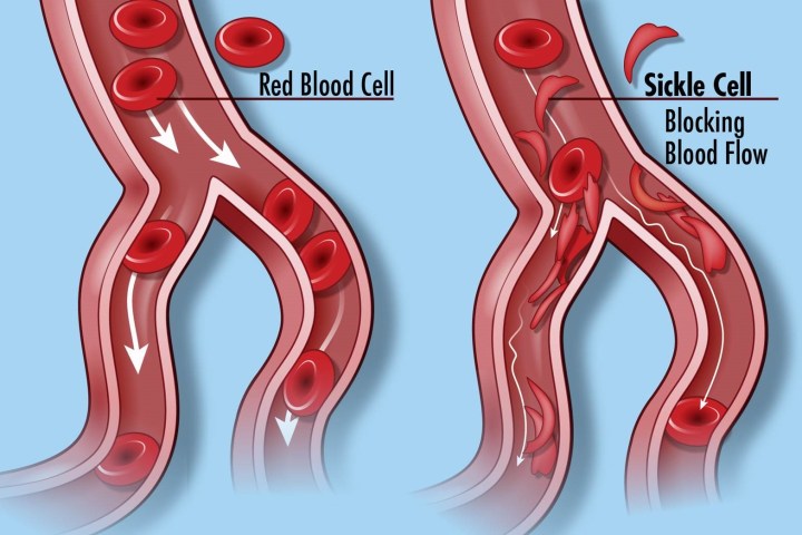 UCT professor’s research offers hope of treatment for sickle cell anaemia