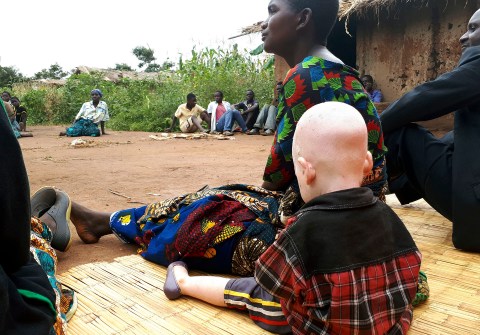 Tanzanians hard hit by murderous trade in trafficking in people with albinism