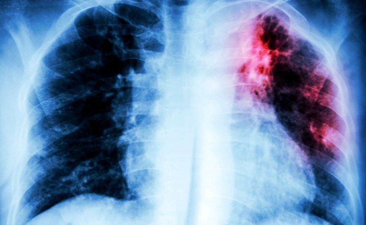SA piloting mobile X-rays to boost asymptomatic TB detection