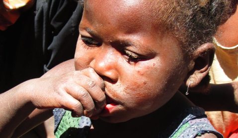 Madagascar’s food crisis: Chronic malnutrition is stunting mental capacity