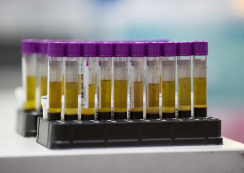 Australia scientists develop ‘world first’ melanoma blood test