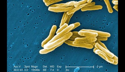 GroundUp: South African study offers hope against drug-resistant TB