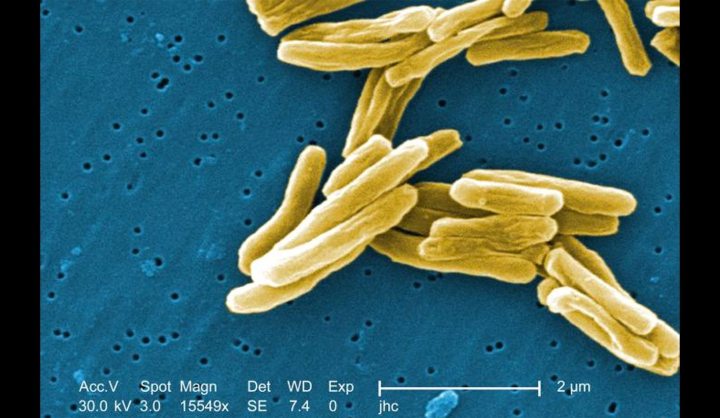 GroundUp: South African study offers hope against drug-resistant TB