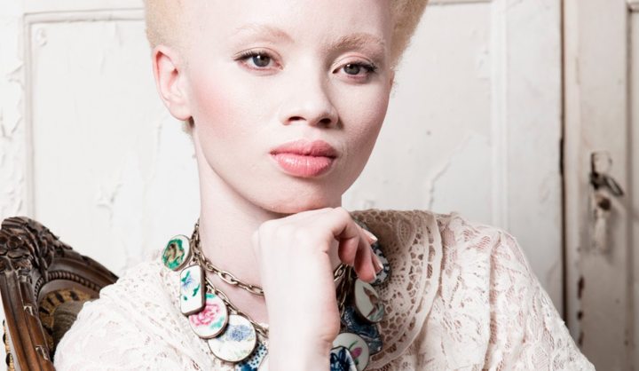No black or white? The complexity of living with albinism