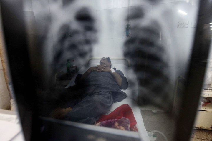 Tens of thousands of people with TB in SA not diagnosed – survey