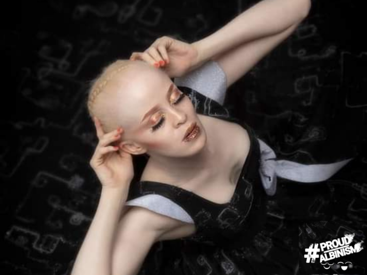 Proud Albinism (Video)